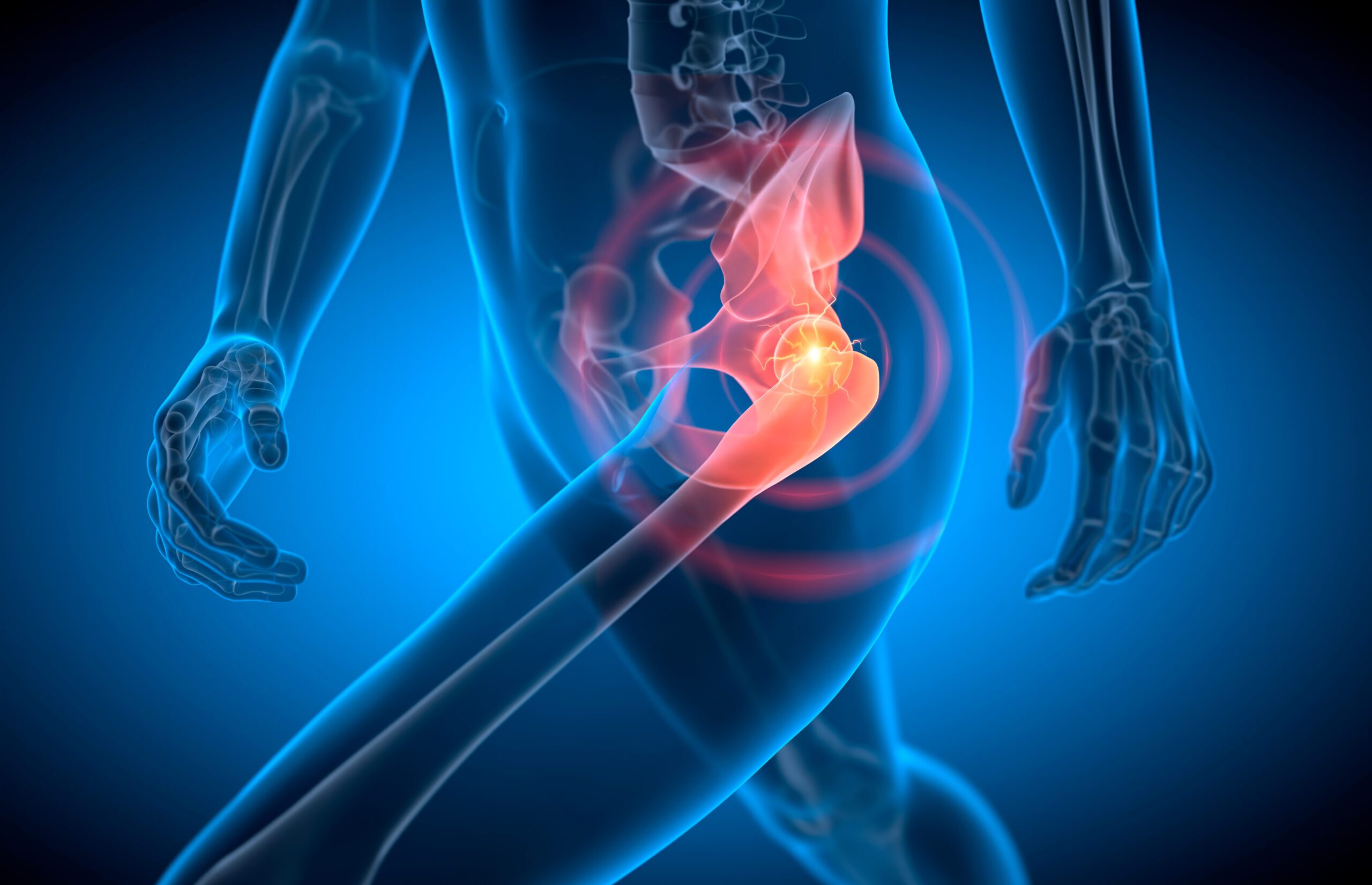 Osteoarthritis of the hip in Boise