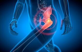 Osteoarthritis of the hip in Boise