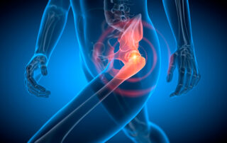 Osteoarthritis of the hip in Boise